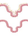 Fecal microbiota transplant (FMT)