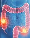 Colon cancer is surging in younger adults and doctors are alarmed3