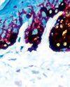 AVANCES EN EL tratamiento del melanoma AVANCES EN EL tratamiento del melanoma7