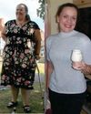 TOOTHLESS AFTER A GASTRIC BYPASS3