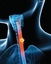 Coping with... OESOPHAGEAL CANCER12