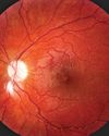 What Is GCA, and What Does It Have to Do With Vision?7