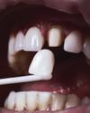 Why Does Everyone Have Big, Fake White Teeth Now?