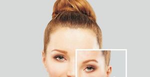 Acne Scars